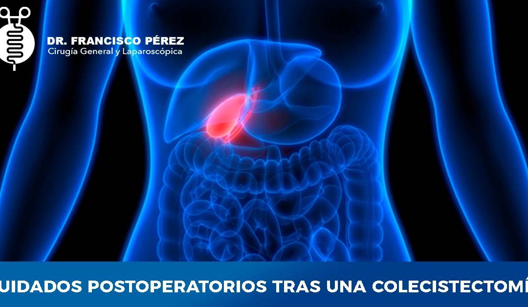 CUIDADOS POSTOPERATORIOS TRAS UNA COLECISTECTOMÍA